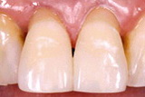Восстановление зубов 